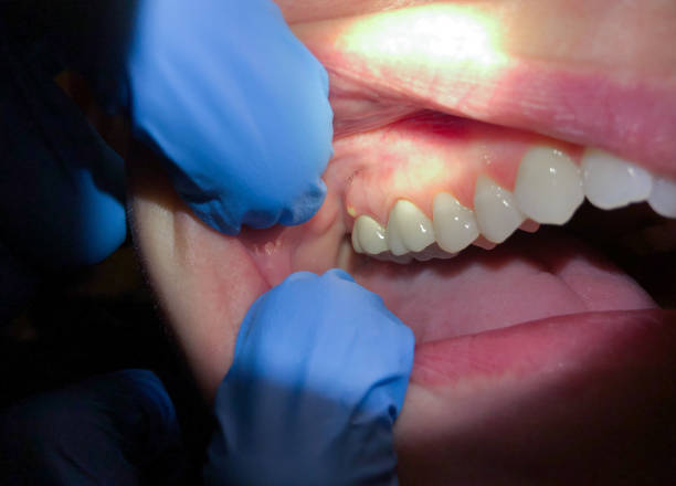 Best Emergency Wisdom Teeth Removal in Shreve, OH