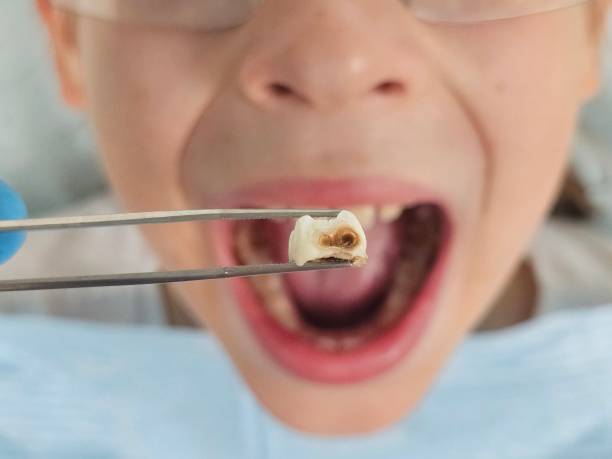 Best Emergency Tooth Extraction in Shreve, OH